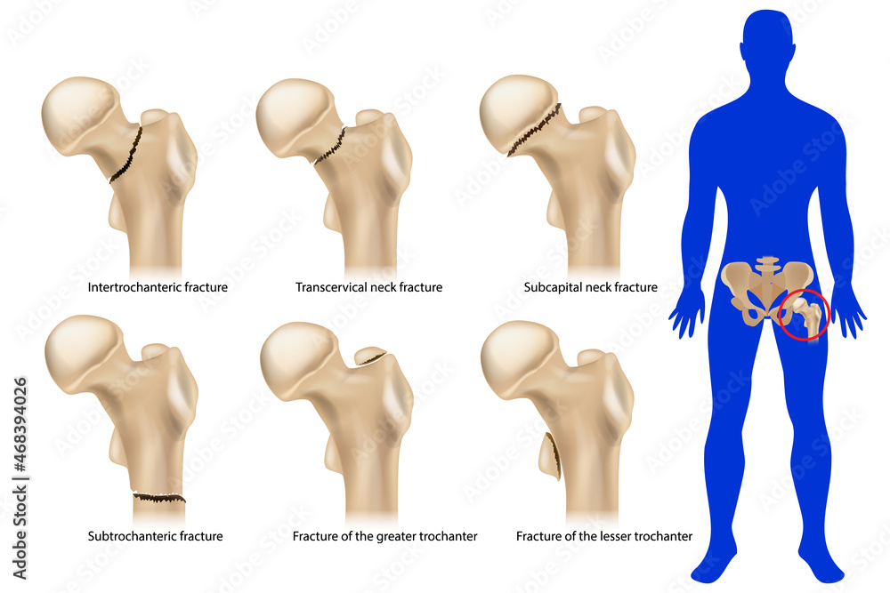 Femoral neck fracture. Types of hip fractures. Subtrochanteric