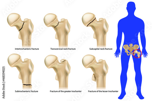 Femoral neck fracture. Types of hip fractures. Subtrochanteric, Intertrochanteric, Transcervical and Subcapital  neck fracture, Fracture of the greater and lesser trochanter. Anatomy photo
