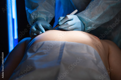 Plastic surgeon doctor prepares for breast reduction surgery on a man, close-up. Liposuction