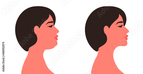 Double chin, before and after. A woman in profile with a drooping second chin and a toned face. Vector illustration, flat cartoon minimal design isolated on white background, eps 10.