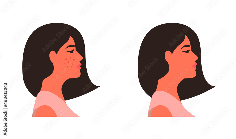 Young woman in profile with and without acne. Before and after. Vector illustration, flat minimal cartoon design isolated on white background, eps 10. Young woman in profile with and without acne. Before and after. Vector illustration, flat minimal cartoon design isolated on white background, eps 10.