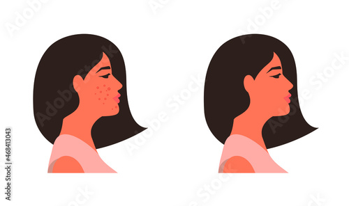 Young woman in profile with and without acne. Before and after. Vector illustration, flat minimal cartoon design isolated on white background, eps 10.