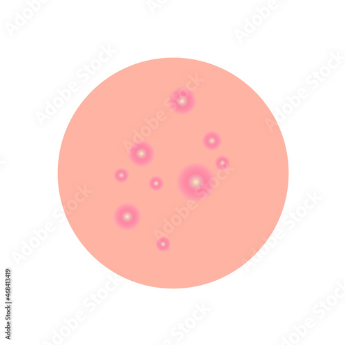 A round piece of skin with pimples. Inflammatory acne on the body. Vector illustration, flat minimal cartoon design isolated on white background, eps 10.