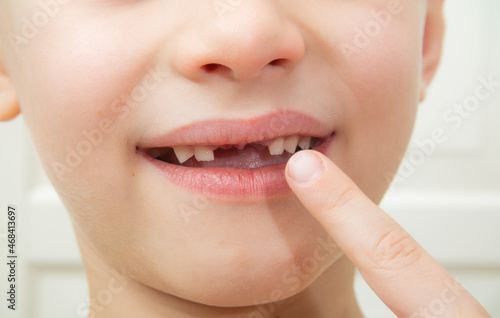Close-up of the boy on the pulled out baby teeth and is in pain. Tooth loss, a concept of dental problems