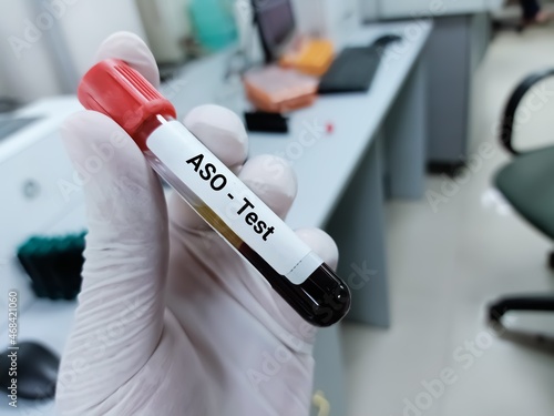 Blood sample for Antistreptolysin O (ASO) titer test. strep infection. Inflammatory disorder. Medical test tube in laboratory background.
