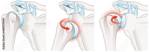 Photos Shoulder dislocation