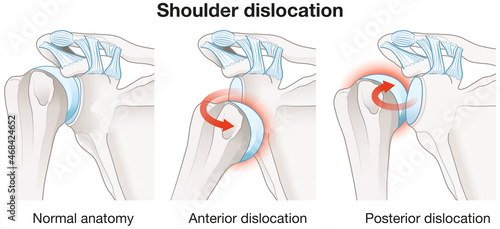 Foto Shoulder dislocation