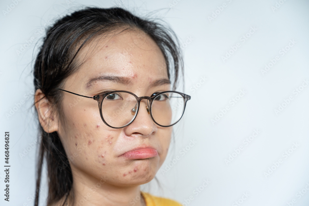 Asian woman having stress cause of acne inflamed on her face. Inflamed acne consists of swelling, redness, and pores that are deeply clogged with bacteria, oil, and dead skin cells. Asian woman having stress cause of acne inflamed on her face. Inflamed acne consists of swelling, redness, and pores that are deeply clogged with bacteria, oil, and dead skin cells.
