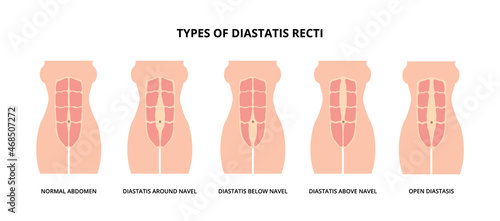 Types of diastasis recti, also known as abdominal separation, common among pregnant women. Abdomen muscles, anatomy, postpartum care 