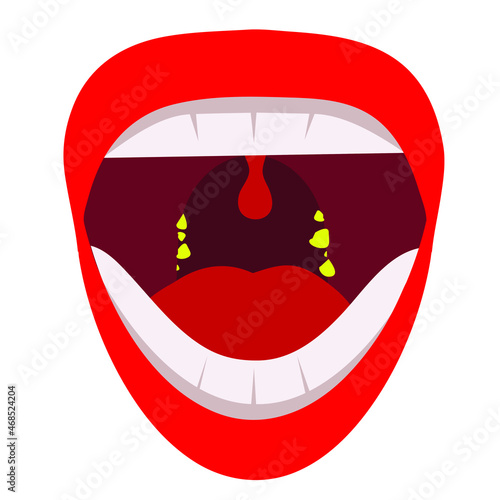 tonsil stone in the mouth vector. Human mouth problem vector illustration. photo
