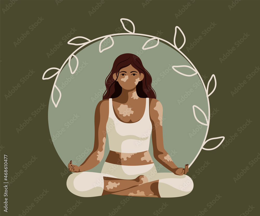 Afro girl with vitiligo, autoimmune depigmentation in yoga lotuse