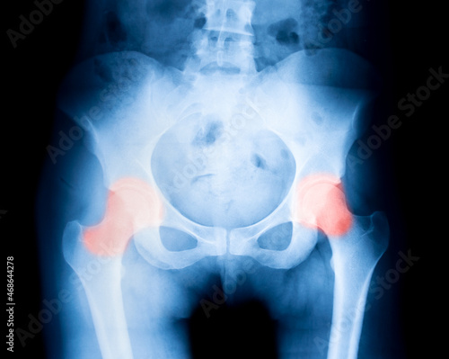 X-ray close up pelvic bone with pain symptoms in joints photo