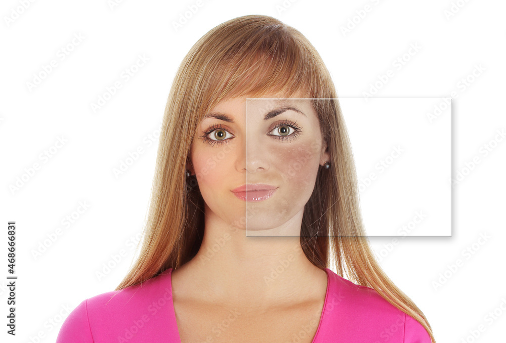 Dark spots, freckles,hyperpigmentation(melasma or chloasma),concept- skin lightening, skin whitening, Skin Brightening. Dark spots, freckles,hyperpigmentation(melasma or chloasma),concept- skin lightening, skin whitening, Skin Brightening.