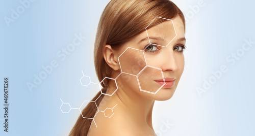 Dark spots, freckles,hyperpigmentation(melasma or chloasma),concept- skin lightening, skin whitening, Skin Brightening.