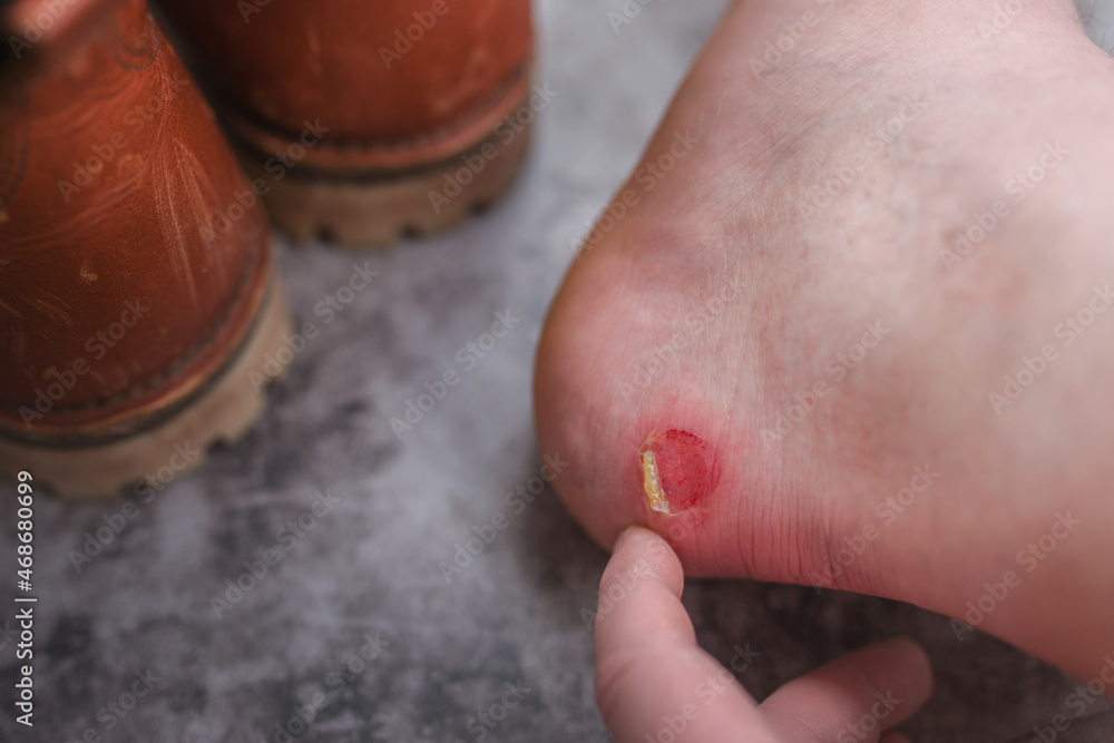 Φωτογραφία A rubbed blister on the heel of the foot caused by severe friction in shoes