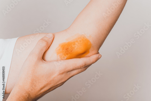 Human left hand elbow injury, close up. Unrecognizable person showing site of injury smeared with iodine anesthetic