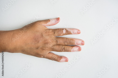 Woman's hand showing vitiligo against white background photo