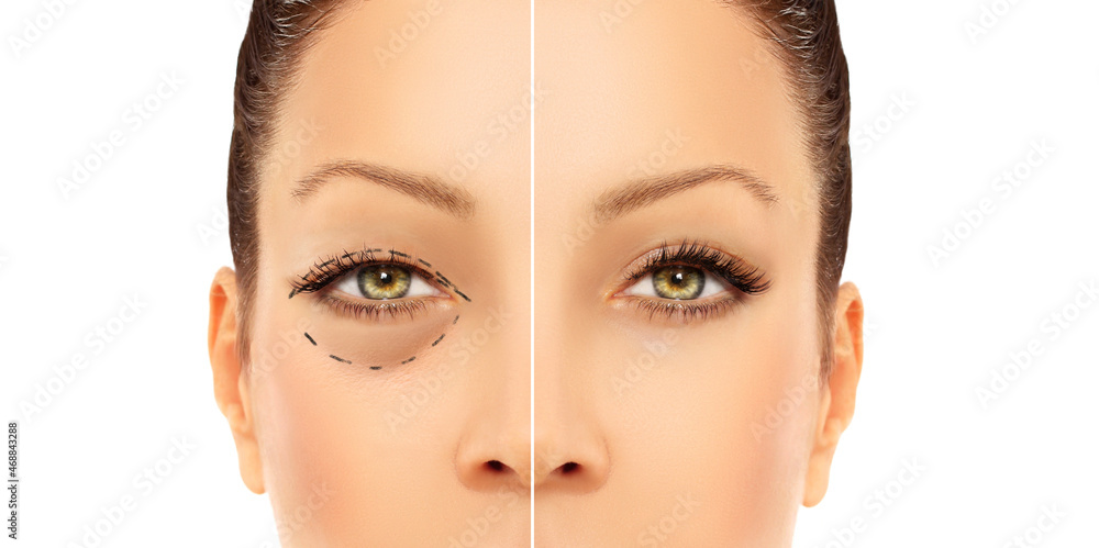 Fototapeta premium Lower eyelid blepharoplasty.Upper blepharoplasty.Before and after cosmetic procedures