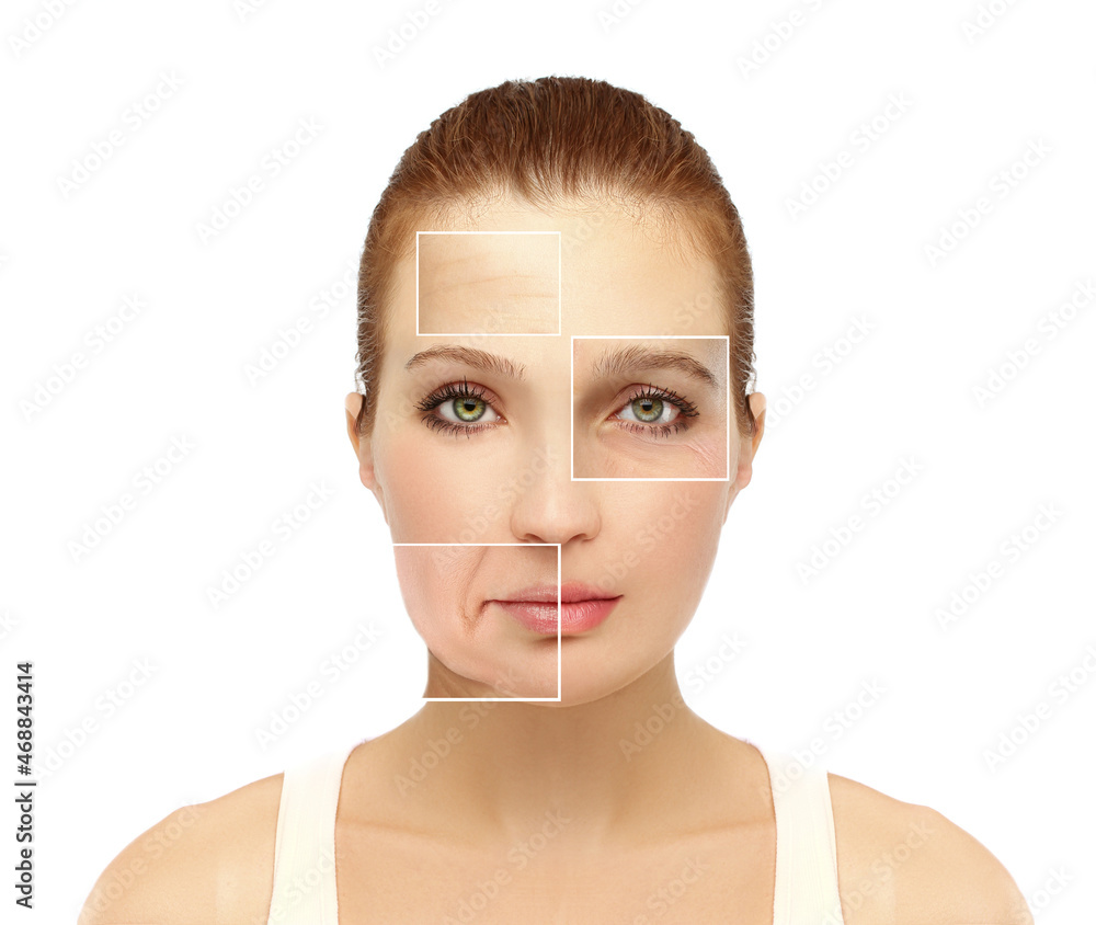 Plastic Surgery Results,Nasolabial folds,Neck ,Under eye circles,neck lines. Plastic Surgery Results,Nasolabial folds,Neck ,Under eye circles,neck lines.
