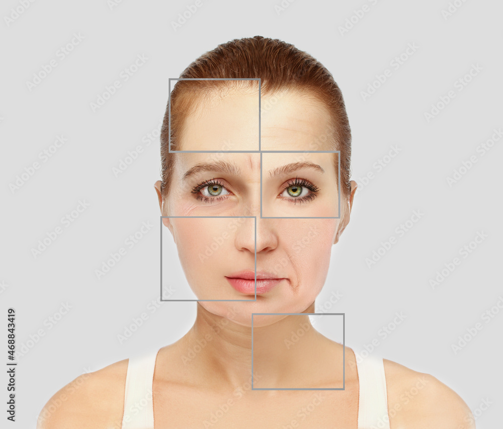 Plastic Surgery Results,Nasolabial folds,Neck ,Under eye circles,neck