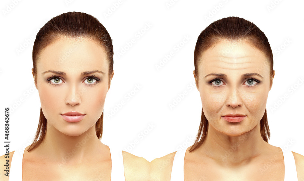 Plastic Surgery Results,Nasolabial folds,Neck ,Under eye circles,neck lines. Plastic Surgery Results,Nasolabial folds,Neck ,Under eye circles,neck lines.