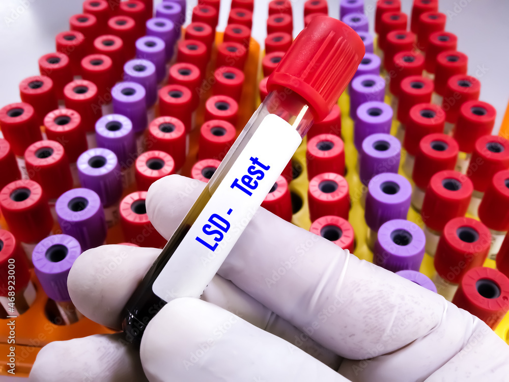 Laboratory sample of blood for doping drugs LSD, test. Doping is the