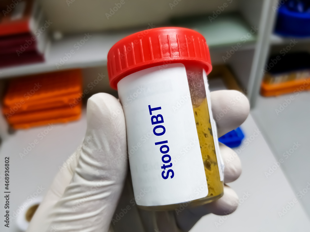 Doctor holding stool sample container for occult blood test (OBT).OBT is a lab test used to check stool samples for hidden (occult) blood at laboratory.