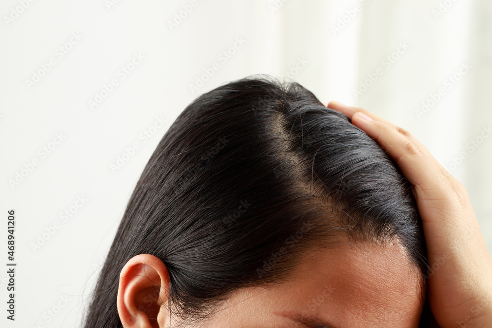 A woman has a problem with hair loss. A woman has a problem with hair loss.