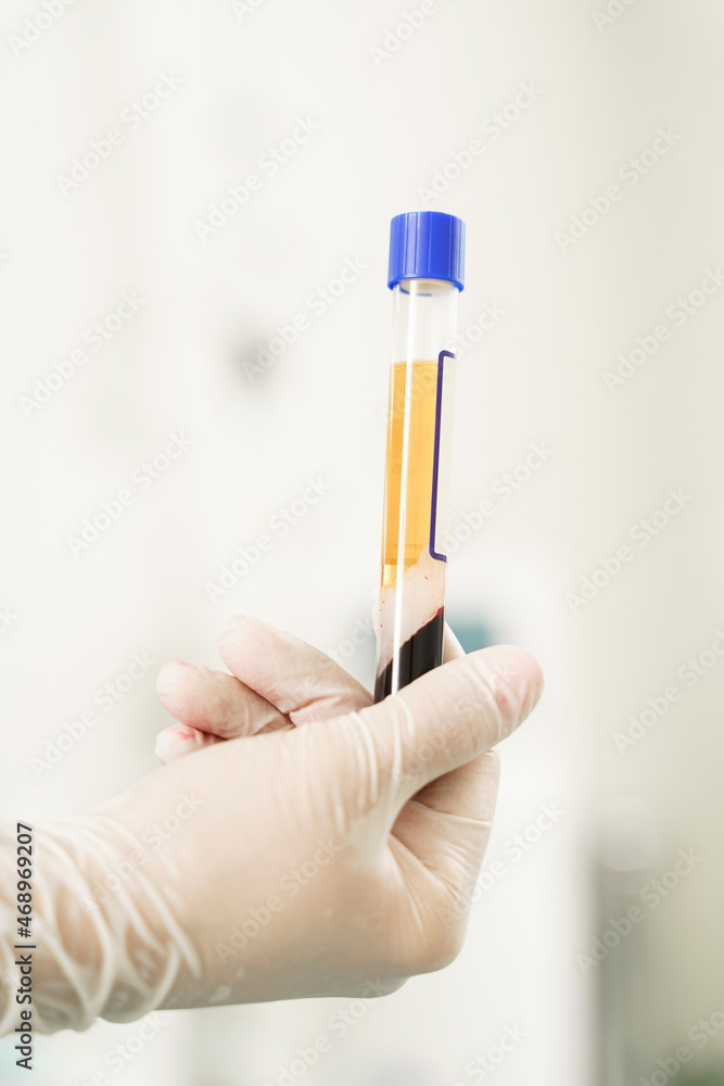 Vacutainer with a platelet-rich plasma and blood for PRP treatment foto de  Stock | Adobe Stock