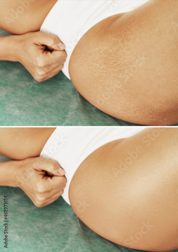 Female hip with comparison before and after stretch marks treatment photo