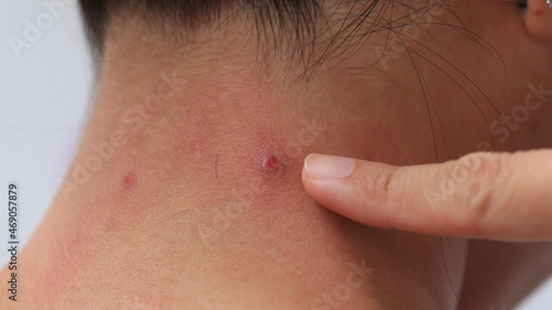 painful inflamed damage acne on neck 