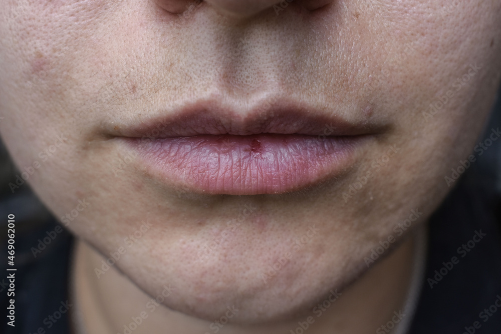 Quarantined home care. lip crack. unkempt face. female antennae Quarantined home care. lip crack. unkempt face. female antennae
