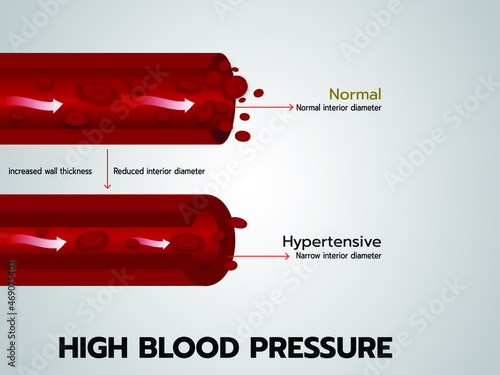 High Blood Pressure and Hypertension 