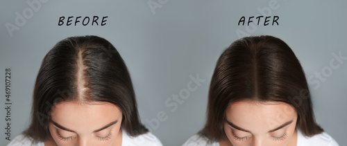 Obraz na plátně Woman with hair loss problem before and after treatment on grey background, collage