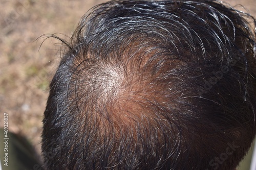 Male baldness, hair loss, early baldness closeup, The concept of scalp health