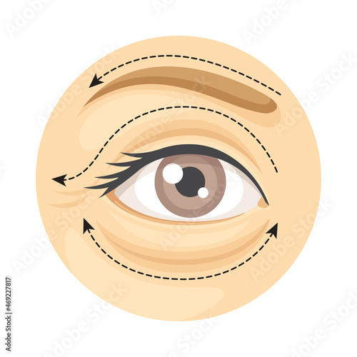 Blepharoplasty cosmetic surgery procedure of female face with dotted lines. Plastic surgery vector illustration