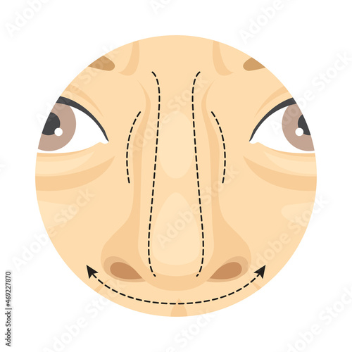 Rhinoplasty cosmetic surgery procedure of female face with dotted lines. Plastic surgery vector illustration
