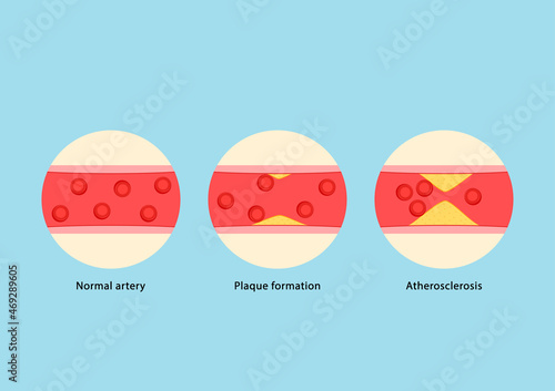 Blood vessel. Atherosclerosis Infographics with Tiny Medic Characters Presenting Human Blood Artery Normal, Plaque Formation and Vessel Blocked with Cholesterol.