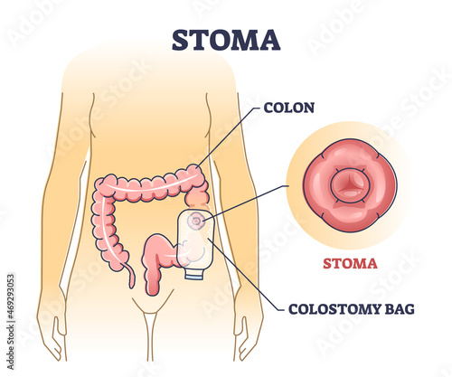 Stoma bag after colon surgery as medical patient drainage outline diagram. Labeled educational digestive problem solution scheme with anatomical gastrointestinal tract procedure vector illustration photo