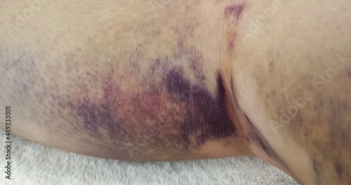 bruised skin on leg of patient, patient skin after knee surgery process, rehabilitation and treatment care, wound of patient after treatment with Minimally Invasive Surgery, anterior cruciate ligament
