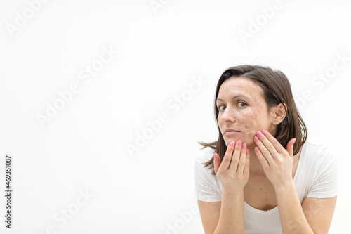 Photo of woman with dry skin touching her face on white background.