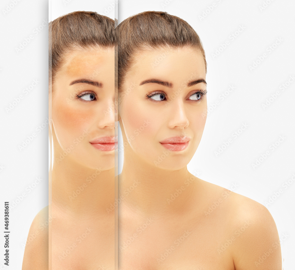 Dark spots, freckles,hyperpigmentation(melasma or chloasma),concept- skin lightening, skin whitening, Skin Brightening. Dark spots, freckles,hyperpigmentation(melasma or chloasma),concept- skin lightening, skin whitening, Skin Brightening.