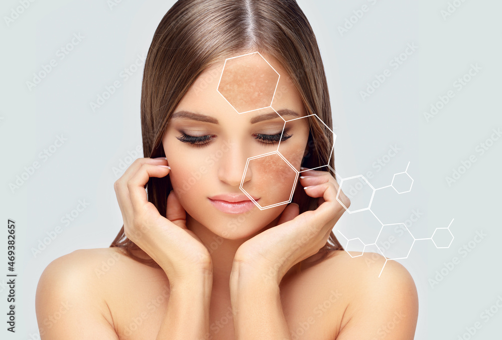 Dark spots, freckles,hyperpigmentation(melasma or chloasma),concept ...