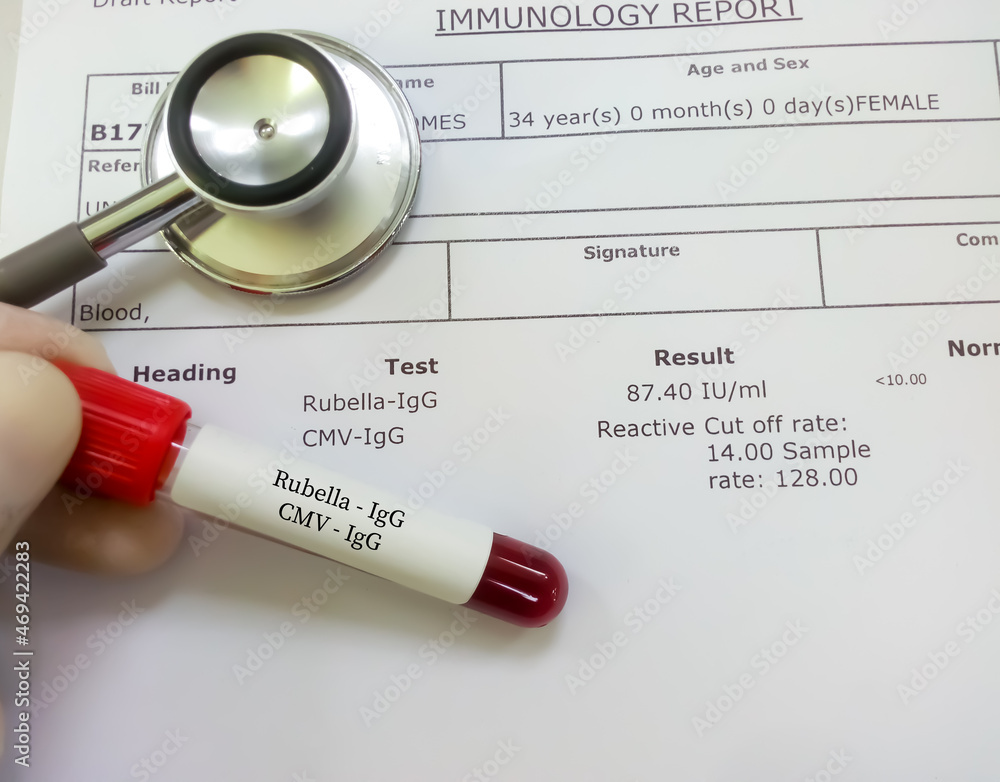 Technician hand hold blood sample with abnormal Rubella IgG and CMV IgG