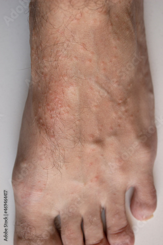 Allergic reaction on the leg. Rash on the foot. Dermatological disease. Pimples on the leg