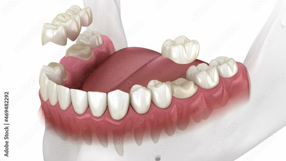 Instalation of dental bridge and single crown. Medically accurate 3D animation Instalation of dental bridge and single crown. Medically accurate 3D animation