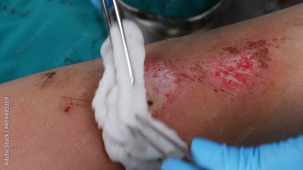 close up doctor cleaning wound on the leg, Injuries from falling Stock