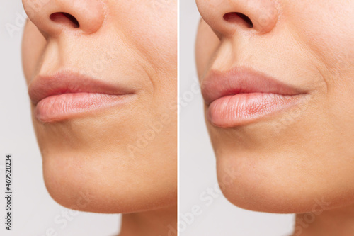 Cropped shot of young women's face with lips before and after lip enhancement on a gray background. Injection of filler in lips. Lip augmentation photo