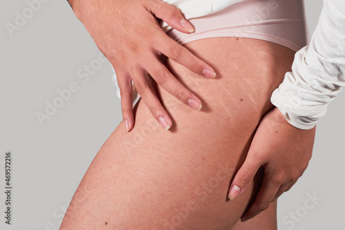 Latin woman leg shows her stretch marks fearlessly. Body positive concept.