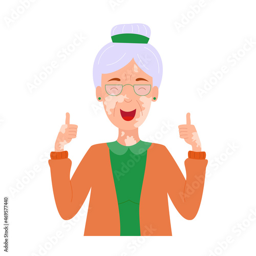 Happy smiling old lady with vitiligo. Senior Grandmother showing thumbs up. World Vitiligo Day. The concept of beauty and self-acceptance at any age. Skin disease. Flat vector illustration.